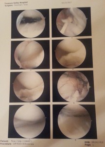 Damaged ACL and Meniscus
