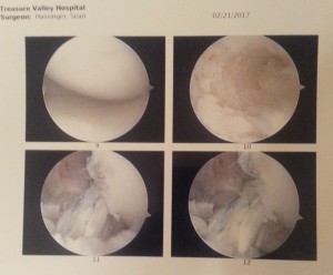 Trimmed meniscus, anchor holes and new ACL